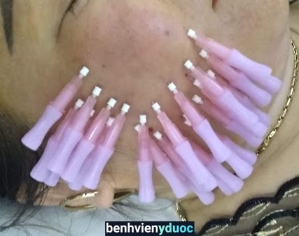 Cấy chỉ - Bấm Huyệt - Châm Cứu |đông y Ngọc Thủy Đường Hà Nội Hoàng Mai Hà Nội
