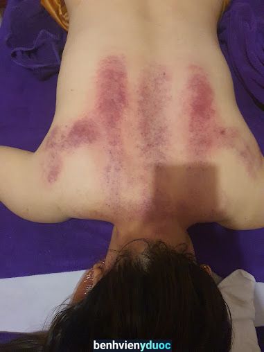 Massage Châm Cứu Ấn Huyệt Trị Liệu - Đà Lạt Đà Lạt Lâm Đồng