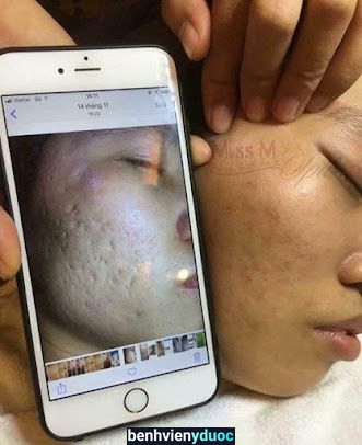 Miss M Spa Pleiku - VUA TRỊ MỤN RỖ NÁM TÀN NHANG SẸO LỒI Pleiku Gia Lai