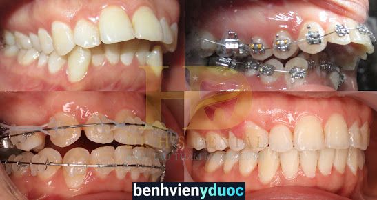 Nha Khoa HD- Niềng răng chuyên sâu, răng sứ thẩm mỹ