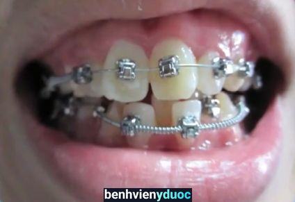 Nha Khoa HD- Niềng răng chuyên sâu, răng sứ thẩm mỹ Vinh Nghệ An