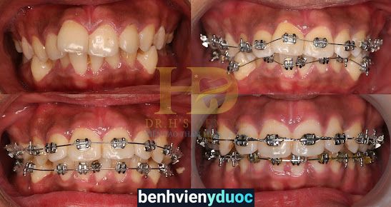 Nha Khoa HD- Niềng răng chuyên sâu, răng sứ thẩm mỹ Vinh Nghệ An