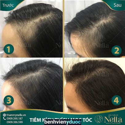 Phòng khám cấy tóc tự thân Nella 3 Hồ Chí Minh