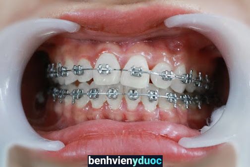 Phòng khám Nha Khoa Quốc Tế VinSmile | Phòng khám răng uy tín Bắc Ninh Từ Sơn Bắc Ninh