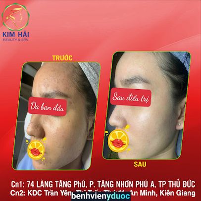 Spa Trị Mụn Quận 9 I Kim Hải Spa Thủ Đức Hồ Chí Minh