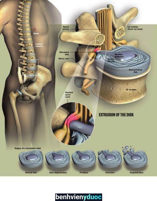 TRỊ LIỆU THẦN KINH CỘT SỐNG NGUYỄN HOÀNG HẢI LONG Hóc Môn Hồ Chí Minh