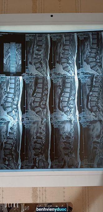 TRỊ LIỆU THẦN KINH CỘT SỐNG NGUYỄN HOÀNG HẢI LONG Hóc Môn Hồ Chí Minh