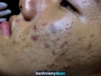 Trung Tâm SPA Trị Mụn Trị Nám Huynh Thảo Hóc Môn Hồ Chí Minh
